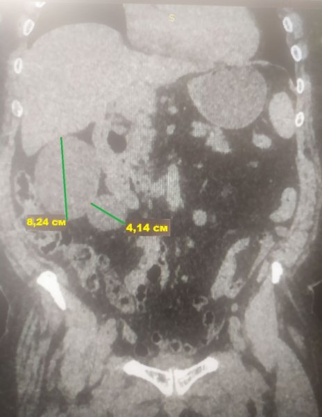 Ковельські лікарі успішно виконали операцію з видалення двох пухлин нирки
