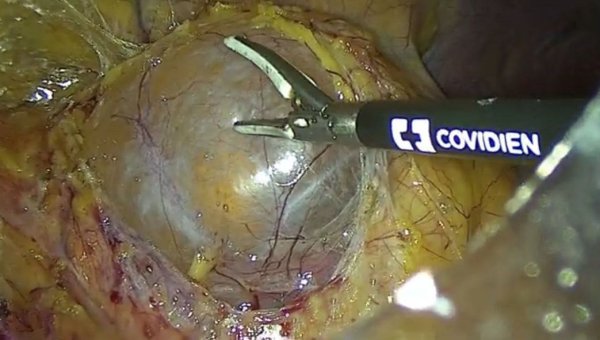 Ковельські лікарі успішно виконали операцію з видалення двох пухлин нирки