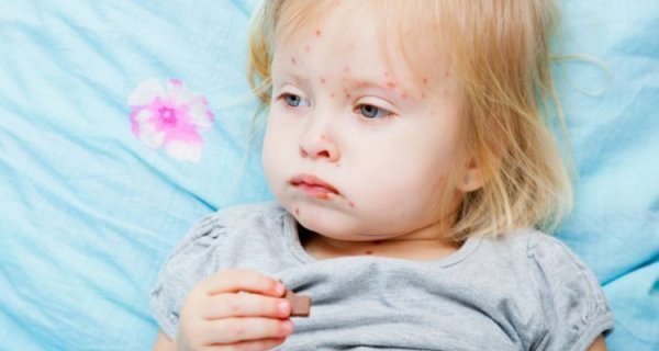 За два дні у Ковелі зафіксували 19 нових випадків захворювання дітей на кір