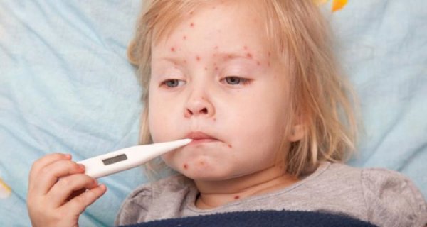 У Ковелі - п'ять нових випадків захворювання на кір