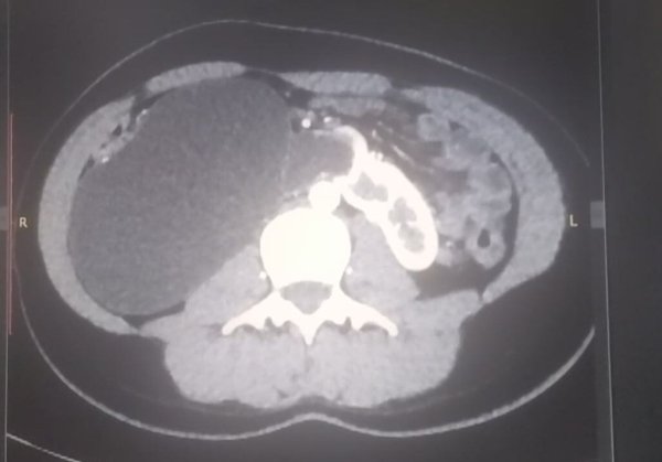 У Ковелі лікарі провели унікальну урологічну операцію та врятували життя молодій дівчині
