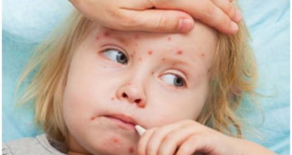 Ситуація із захворюваністю на кір залишається напруженною