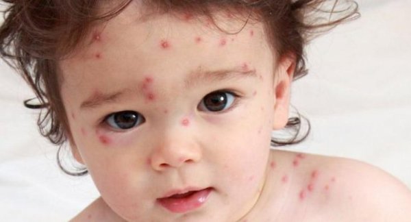 У Ковелі ще 9 осіб захворіли на кір