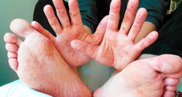 І знову про кір: за цей тиждень у Ковелі захворіло ще 53 особи