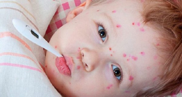 Рівень захворюваності на кір у Ковелі дещо знизився